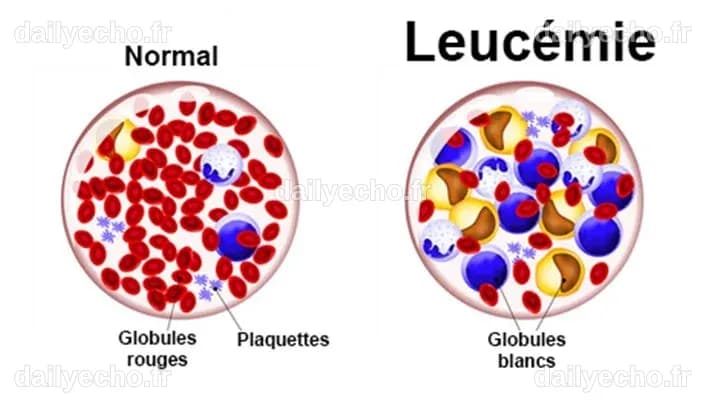 Leucémie : symptômes, traitement, définition - docteurclic.com